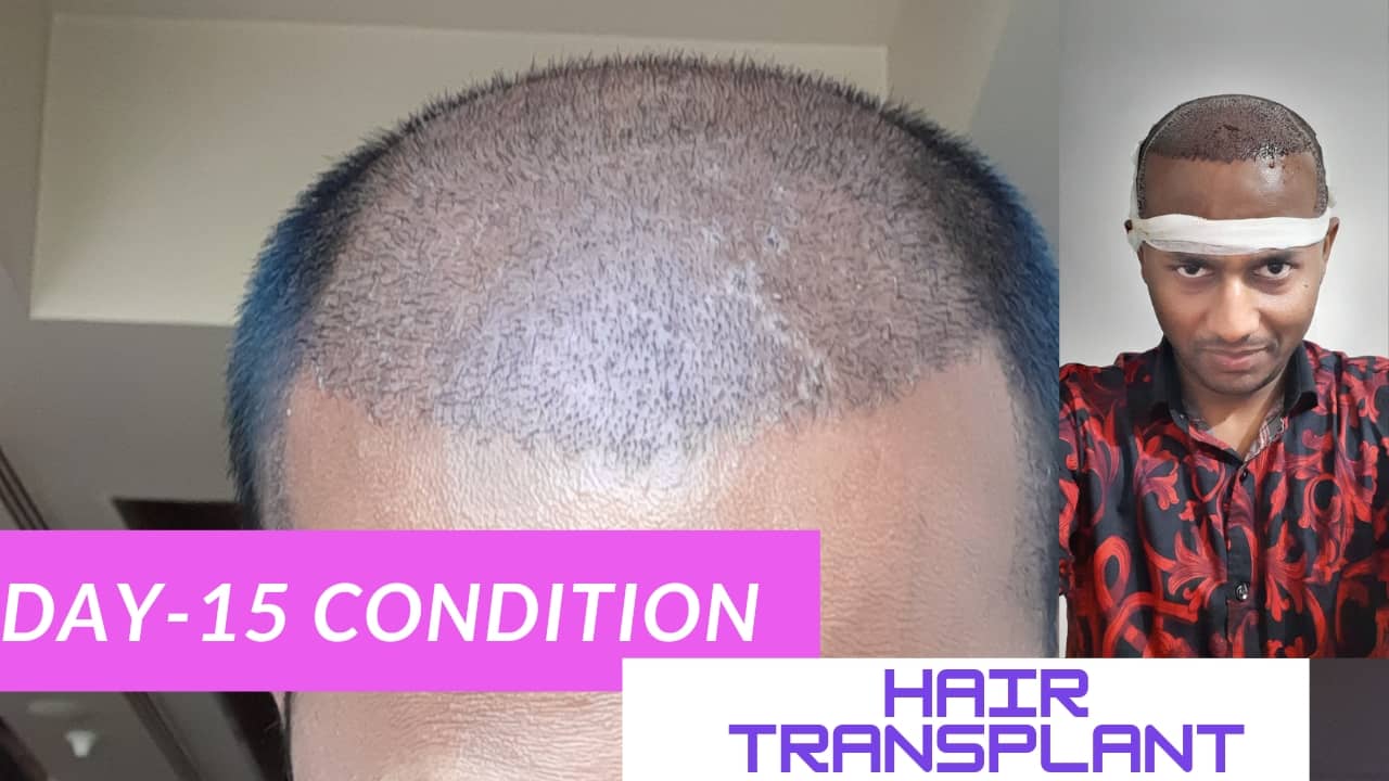 Hair Transplant day 15 condition