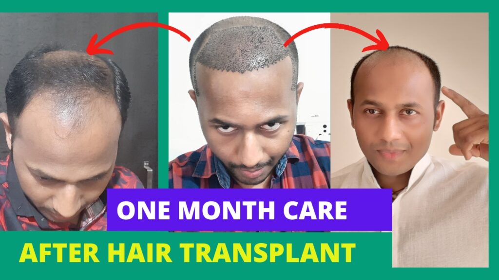 My hair fall, Hair Transplant Journey and Shedding face after hair transplant Journey. One Month Condition of my Hair Transplant.